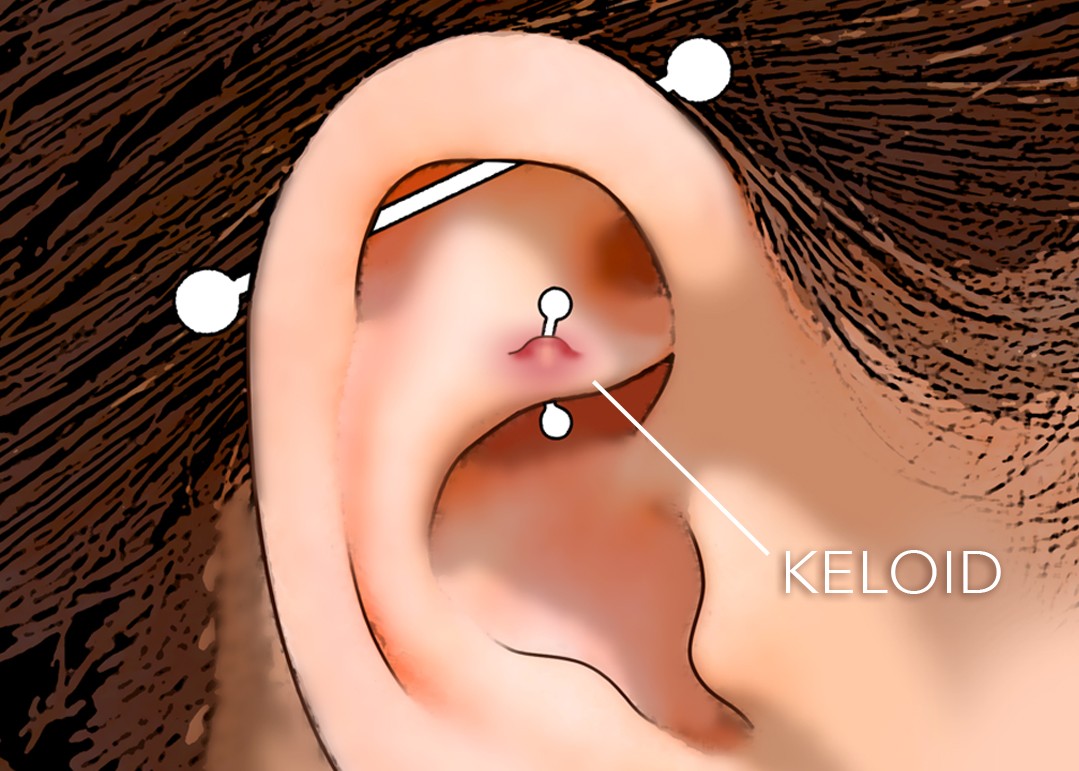 Is It a Keloid or An Irritation Bump?