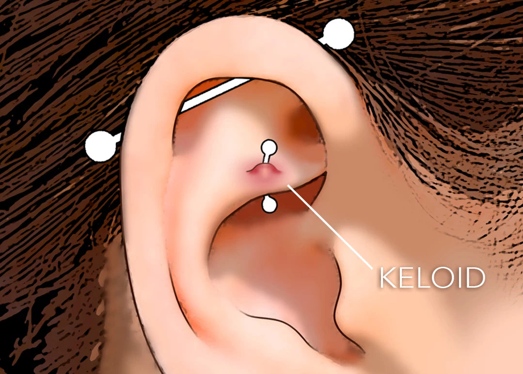 Keloid or Piercing Bump?