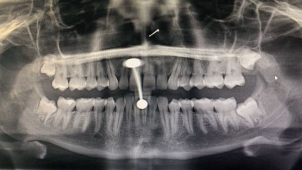 10 Fascinating Pictures of Body Jewelry in X-Rays